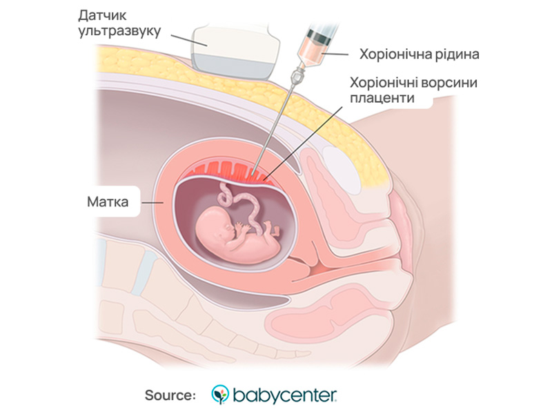 Біопсія ворсин хоріона: рання пренатальна діагностика